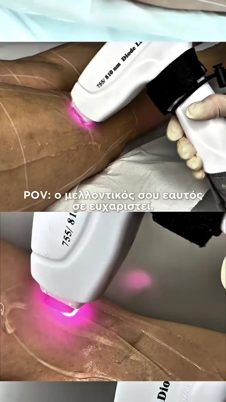 Αποτρίχωση με laser